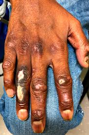 Image result for Leprosy