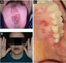 Image result for Erythroplakia roof of mouth
