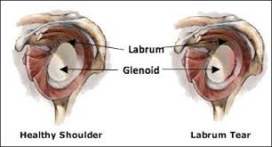 With most daily physical activities requiring if you are having shoulder pains and would like to know if your labrum is torn, allow these steps to guide you. Shoulder Labral Tear Treatment Bethesda Sports Medicine Rockville
