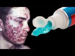 4 cara menghilangkan jerawat jerawat merupakan masalah bagi beberapa orang, apalagi jika munculnya di daerah yang mudah terlihat. Wajib Ditiru Menghilangkan Jerawat Menggunakan Pasta Gigi Kaskus