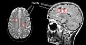 È complessa e imprevedibile, ma non è contagiosa né mortale. Sclerosi Multipla E Come Viverla Assistenza Amica