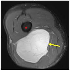 Image result for Liposarcoma