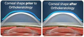 Everything You Need To Know About Orthokeratology Visionplus Magazine