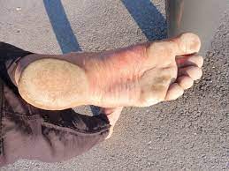 Just use your common sense, and think about whether going barefoot could damage your feet. If You Walk Barefoot All The Time Do Your Feet Become Resistant To The Tough Ground Quora