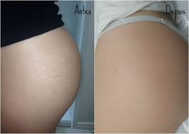 O Que E Bom Para Tirar Estrias Na Barriga Ou No Braco Como Tirar Estrias Remocao De Estrias Tratamento De Pele