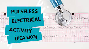 Image result for Pulseless Electrical Activity