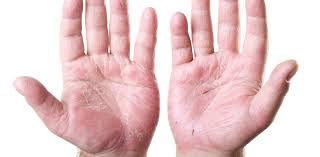 11 Early Psoriatic Arthritis Symptoms You Should Know Paindoctor Com