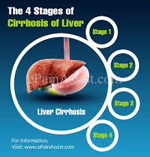 The normal functioning of liver is affected by cirrhosis. The 4 Stages Of Cirrhosis Of Liver Cirrhosis Heal Liver Fatty Liver Diet
