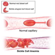 Sickle cell anemia is one of a group of disorders known as sickle cell disease. Sickle Cell Disease Wikipedia