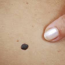 Wie erkennt man gefährliche muttermale? Leberflecken Und Muttermale Wann Entfernen
