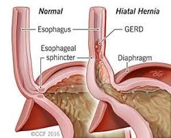 A Hiatal Hernia Occurs When The Upper Part Of The Stomach Pushes Through An Opening In The Di Hiatal Hernia Diet Hernia Symptoms Natural Remedies For Heartburn