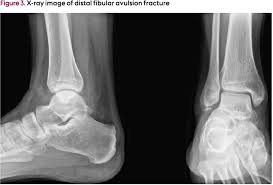 Indications for conservative or operative treatment are discussed in detail. A Comparison Of Two Interventions In The Treatment Of Severe Ankle Sprains And Lateral Malleolar Avulsion Fractures