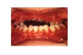 Gigi palsu bisa menghitam gara gara minum kopi/dentures. Gigi Atas Anak Tinggal Sedikit Akibat Karies Bolehkah Dicabut Halaman All Kompas Com