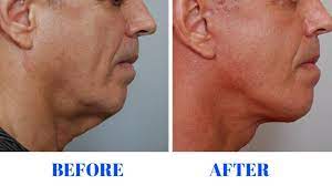 During most jowl lifts, a surgeon will make a cut along the side of the face and under the chin, then reposition and sculpt fat and tissues in the jaw and cheek. How To Get Rid Of Jowls And Turkey Neck Youtube