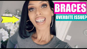 How to fix a gummy smile with braces. Do Braces Give You A Gummy Smile