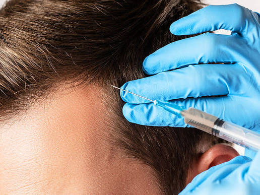 PRP Treatment for Hair Loss | Rise Medical Aesthetics