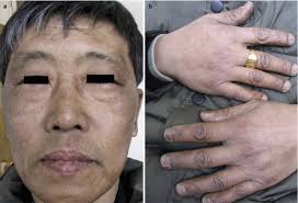 Miscellaneous Hyperpigmentation or Hypermelanosis