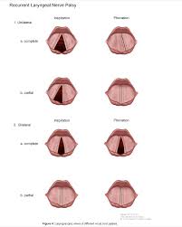 Image result for Vocal Cord Dysfunction