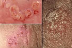Image result for gonorrhea symptoms