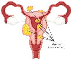 Myofascial release like never seen before. Myomen Kenniscentrum Gynaecologie Slingeland Ziekenhuis