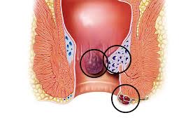 Image result for hemorrhoids