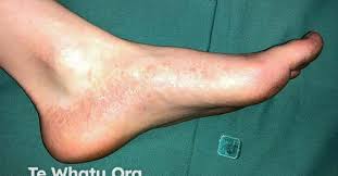 Image result for pompholyx soles of feet