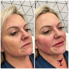 I would like to ask if there is any gentle way to improve my high  cheekbones after my grandmother had her cheekbones shaved..