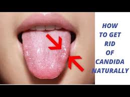 7 Tips How To Get Rid Of Candida Yeast Infections Naturally Cure With Home Remedies Youtube Yeast Infection Relief Yeast Infection Cure Candida Yeast
