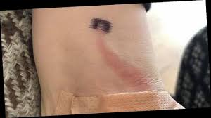 What is sepsis?what causes sepsis?who is at risk?i think i might have sepsis. Mum S Sepsis Warning After Red Line Appears On Son S Arm When He Cut His Hand Opera News