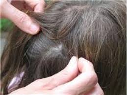Lice prefer long hair because it's easier to access. Do Lice Like Clean Or Dirty Hair Better Change Comin
