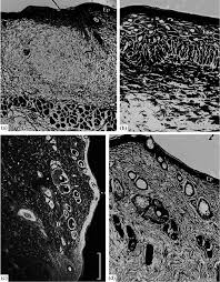 The burns are not always visible as open wounds. Transverse Sections Of Damaged Sites Of Rat Skin After Chemical Burn Download Scientific Diagram