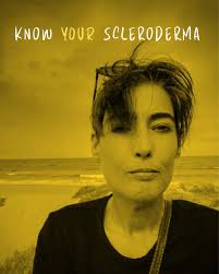 Has anyone had limited systemic sclerosis (CREST) that changed to Diffuse?