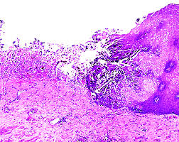 Herpes esophagitis is a viral infection of the esophagus caused by herpes simplex virus (hsv). Pathology Outlines Herpes Simplex Esophagitis