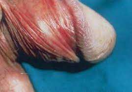 Die schleimhaut (innere vorhaut) und das vorhautbändchen (frenulum), sind besonders sensitiv und am sexuellen empfinden beteiligt. Die Vorhaut Beschneidung Von Jungen