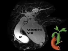Image result for acholic stools human