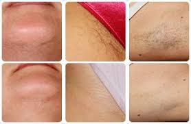 Electrolysis and laser hair removal are similar in several ways: Gentle Treament Electrolysis Permanent Hair Removal Home Facebook