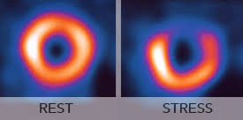 Image result for Nuclear Ventriculogram