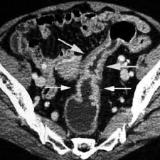 In fact, cat and mri scans can find these two kinds of cancer even when they are being used to detect other problems inside the body. Ct Scan Is Correctly Staged For Sigmoid Tumor Confined To Colonic Wall Download Scientific Diagram