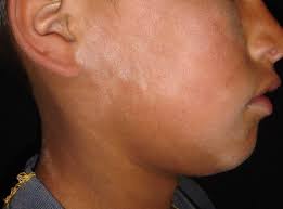 The australasian college of dermatologists (acd). Pityriasis Alba Flashcards Quizlet