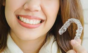 Adelos, è un sistema che consente un riallineamento ortodontico dei tuoi denti senza l'utilizzo di fastidiosi e antiestetici apparecchi metallici ma tramite una serie di sottilissime mascherine per l'allineamento dei denti invisibili e assolutamente confortevoli. Un Approccio Modulare Per Un Controllo Del Risultato Adelos Allineatori Mascherine Invisibili Per Allineamento Ortodontico Denti