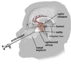 Endoscopic Pituitary Surgery Transsphenoidal Cincinnati Oh Mayfield Brain Spine Pituitary Gland Tumor Cushings Syndrome Sinusitis