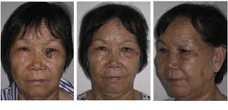 Reconstruction of skin defects in the medial cheek using lateral cheek  rotation flap combined with Z-plasties.