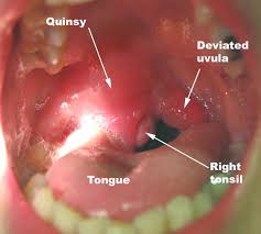 Image result for Peritonsillar Abscess
