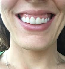 How Can I Fix My Canted Smile? : R/Invisalign