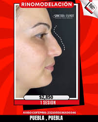 ✨ Perfilamiento Nasal