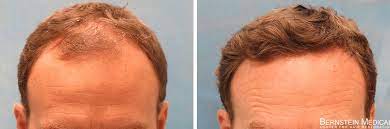 Female hair loss is typically genetic, but may be caused by a number of conditions. Bernstein Medical On Twitter Finding A Hair Transplant Surgeon Is One Of The Most Important Medical Decisions You Will Make Here Are Our Tips For Selecting A Doctor Https T Co Ubjvlkufzb Https T Co Ppd3zwptc6