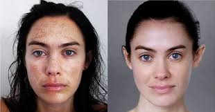 Carbon Skincare Is Coming Facial Peel Chemical Peel Microdermabrasion