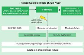 Acute On Chronic Liver Failure In Patients With Alcohol Related Liver Disease Journal Of Hepatology