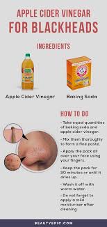 How To Remove Blackheads With Apple Cider Vinegar Blackheads Get Rid Of Blackheads Apple Cider