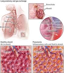 These abnormalities may be due to a disease of the pulmonary interstitial tissue, the bronchial tree, the cardiovascular system or to abnormal alveolar filling with fluid, blood, cells or tumor, several of these etiologies possibly being concomitant. What Are Lung Opacities Kaggle